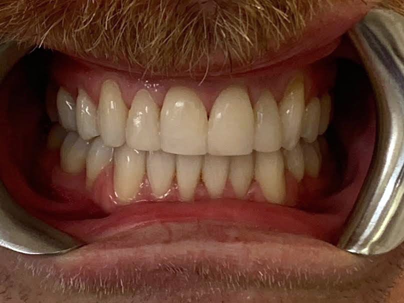 0-3 (500 x 375) Invisalign - White House Dental Studio - Milton Keynes