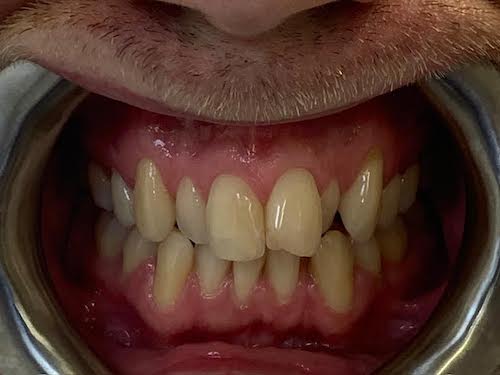 0-3 Invisalign - White House Dental Studio - Milton Keynes