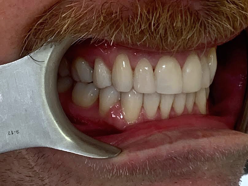 0-4 Invisalign case studies - White House Dental Studio - Milton Keynes
