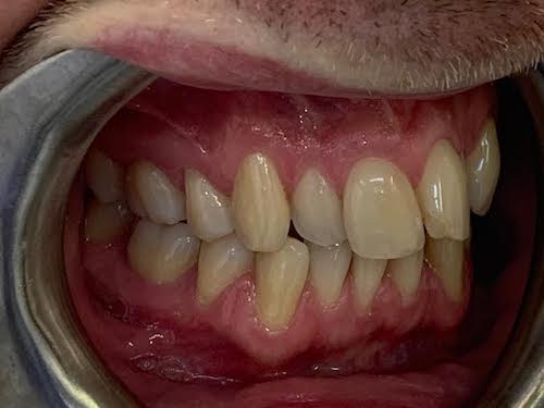 0-4 Invisalign case studies - White House Dental Studio - Milton Keynes