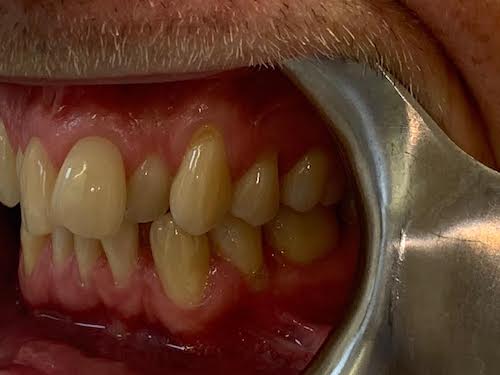 0-5 Invisalign case studies - White House Dental Studio - Milton Keynes