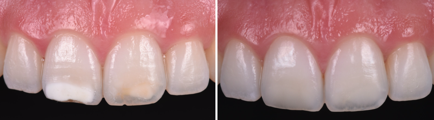 Fixing teeth white spots - Bucks 