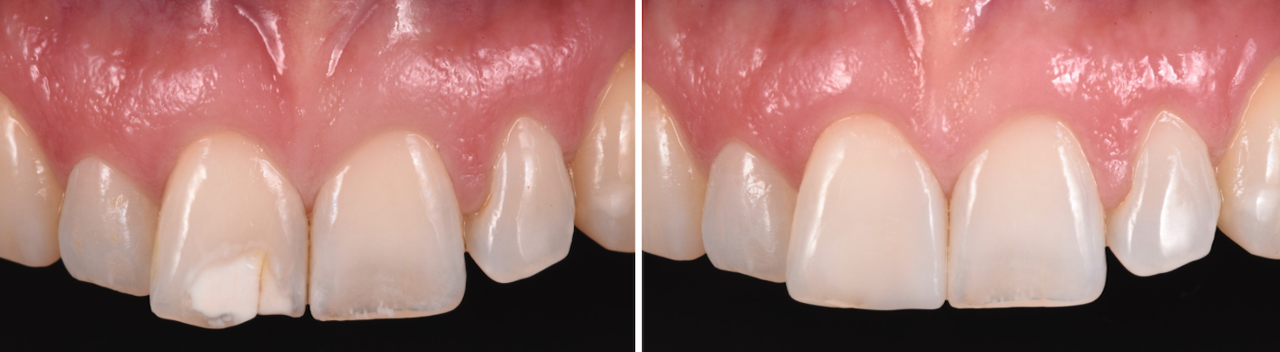 Tooth White Spot Dental Treatment
