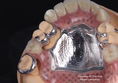 Partial dentures
